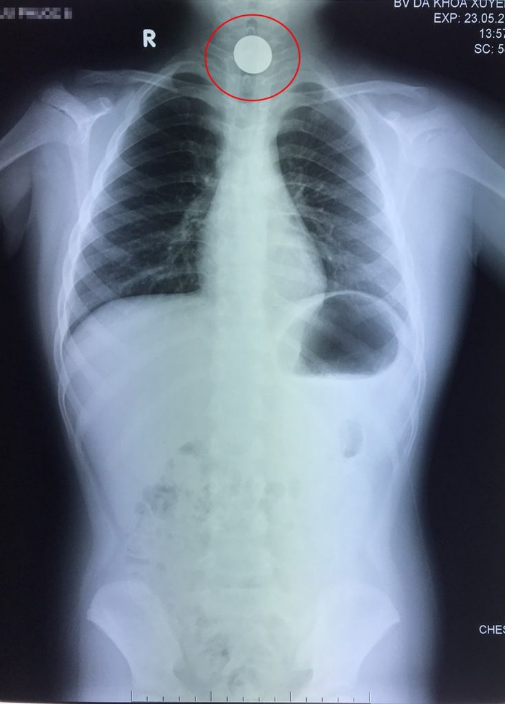 Hình chụp Xquang ngực cho thấy dị vật mắc trong cổ bé rất to, hình tròn nằm chiếm hết lòng đầu trên thực quản, gần ngay ngã thông với đường thở.