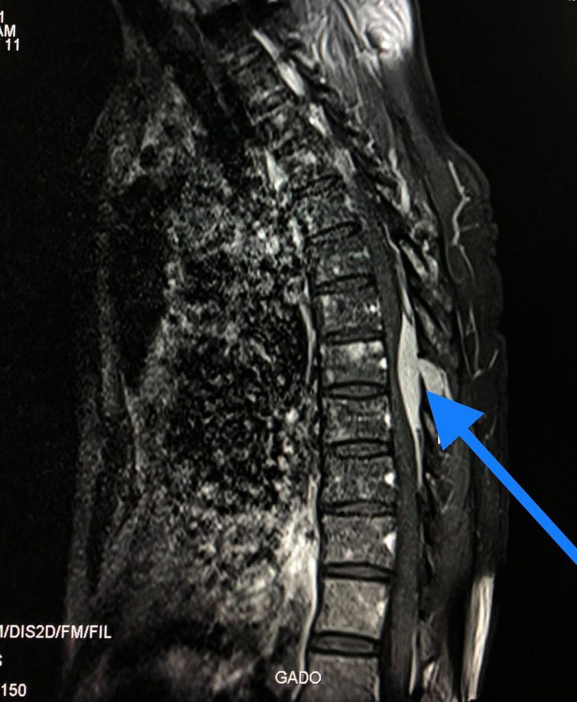 Ảnh chụp MRI cột sống ngực có bơm thuốc cản từ ghi nhận tổn thương trong ống sống ngoài màng cứng ngang mức D8-D9 bắt thuốc cản từ, có hiệu ứng choán chỗ chèn ép tủy cùng mức nặng.