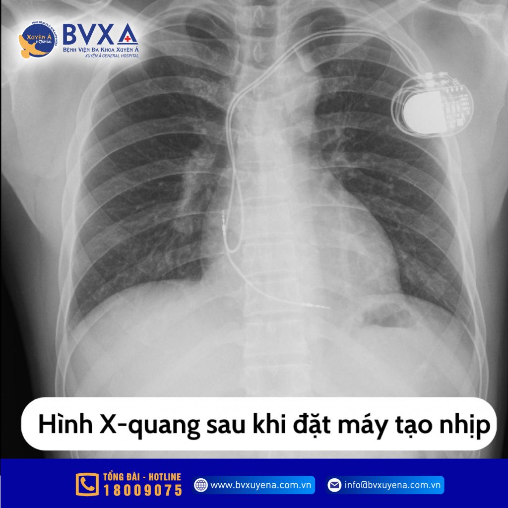 Hình ảnh X-quang sau khi đặt máy tạo nhịp vĩnh viễn