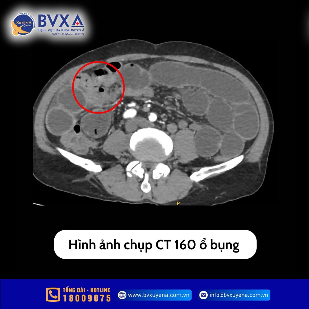 Hình ảnh chụp CT 160 lát cắt bệnh nhân bị tắc ruột ở người cao tuổi