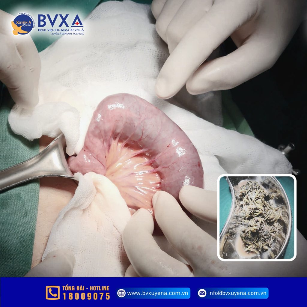 Hình ảnh quá trình phẫu thuật bệnh nhân bị tắc ruột ở người cao tuổi