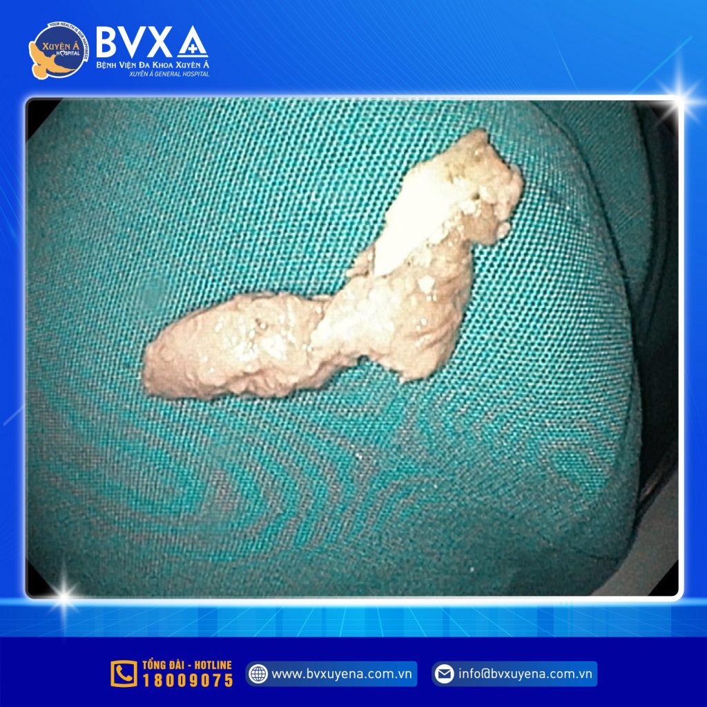 Hình ảnh xương vịt được lấy ra khỏi thực quản