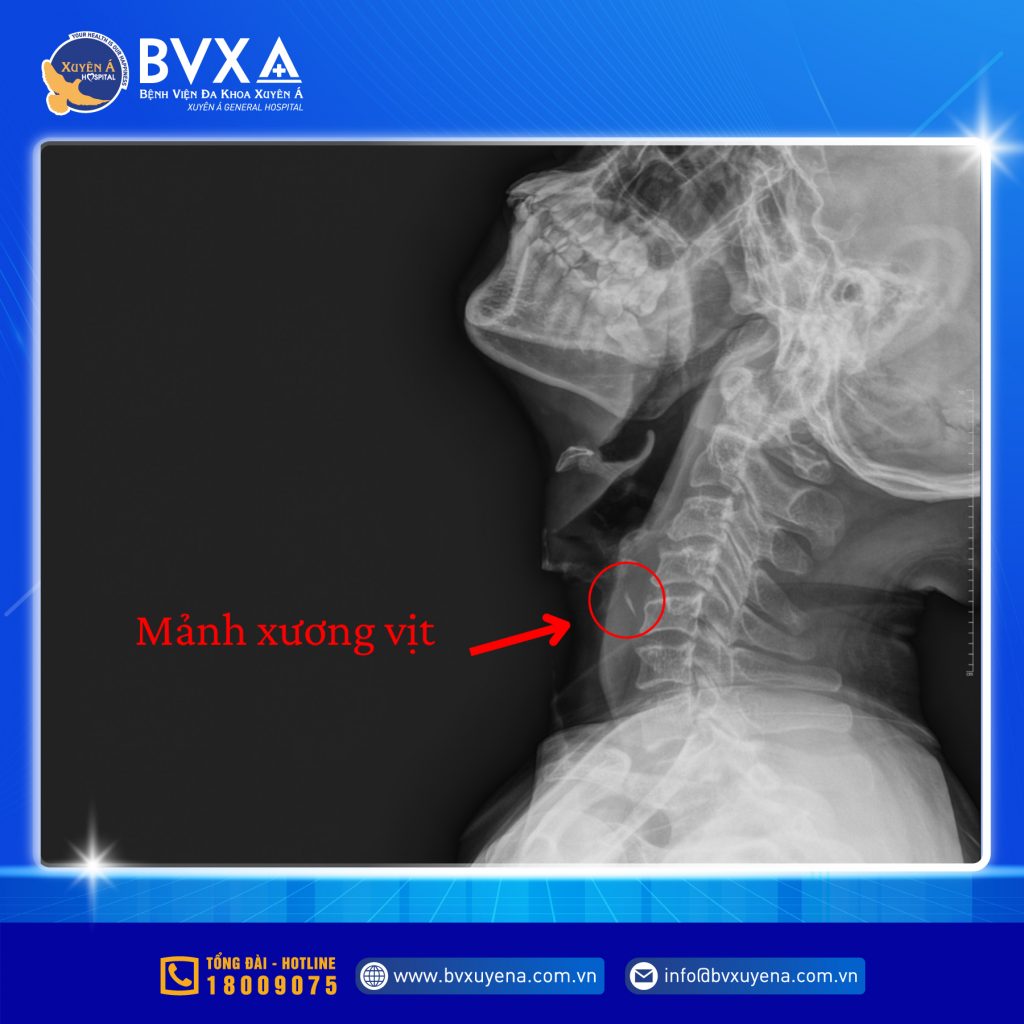 Hình ảnh X-Quang người đàn ông bị mắc xương vịt giữa thực quản