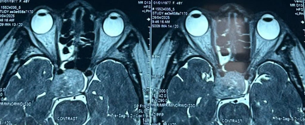 Hình ảnh MRI bệnh nhân H.T.L bị u tuyến yên