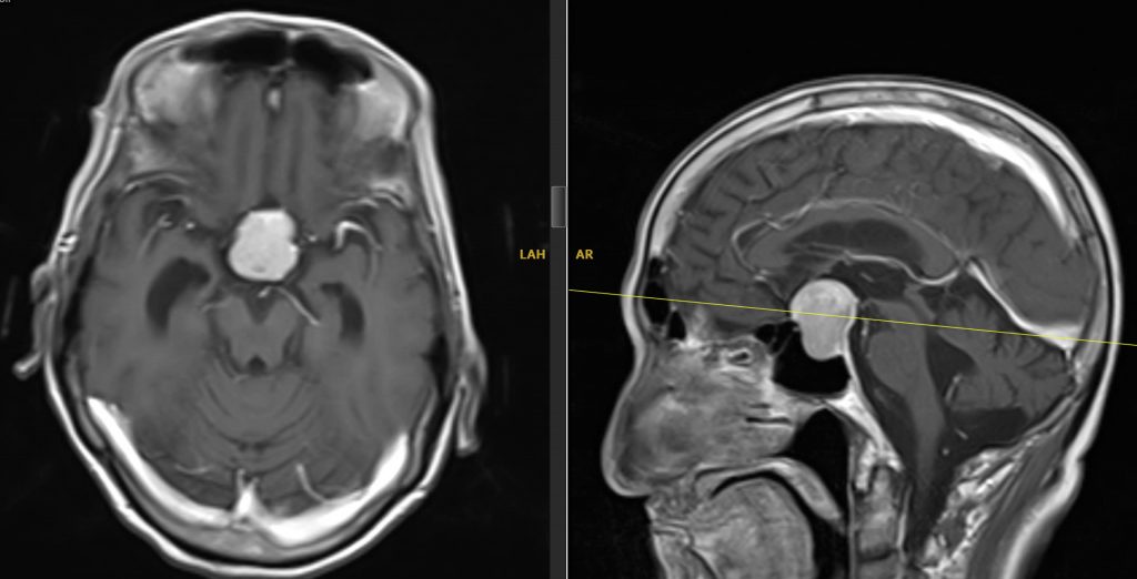 Hình ảnh MRI khối u tuyến yên 3cm của bn N.V.H
