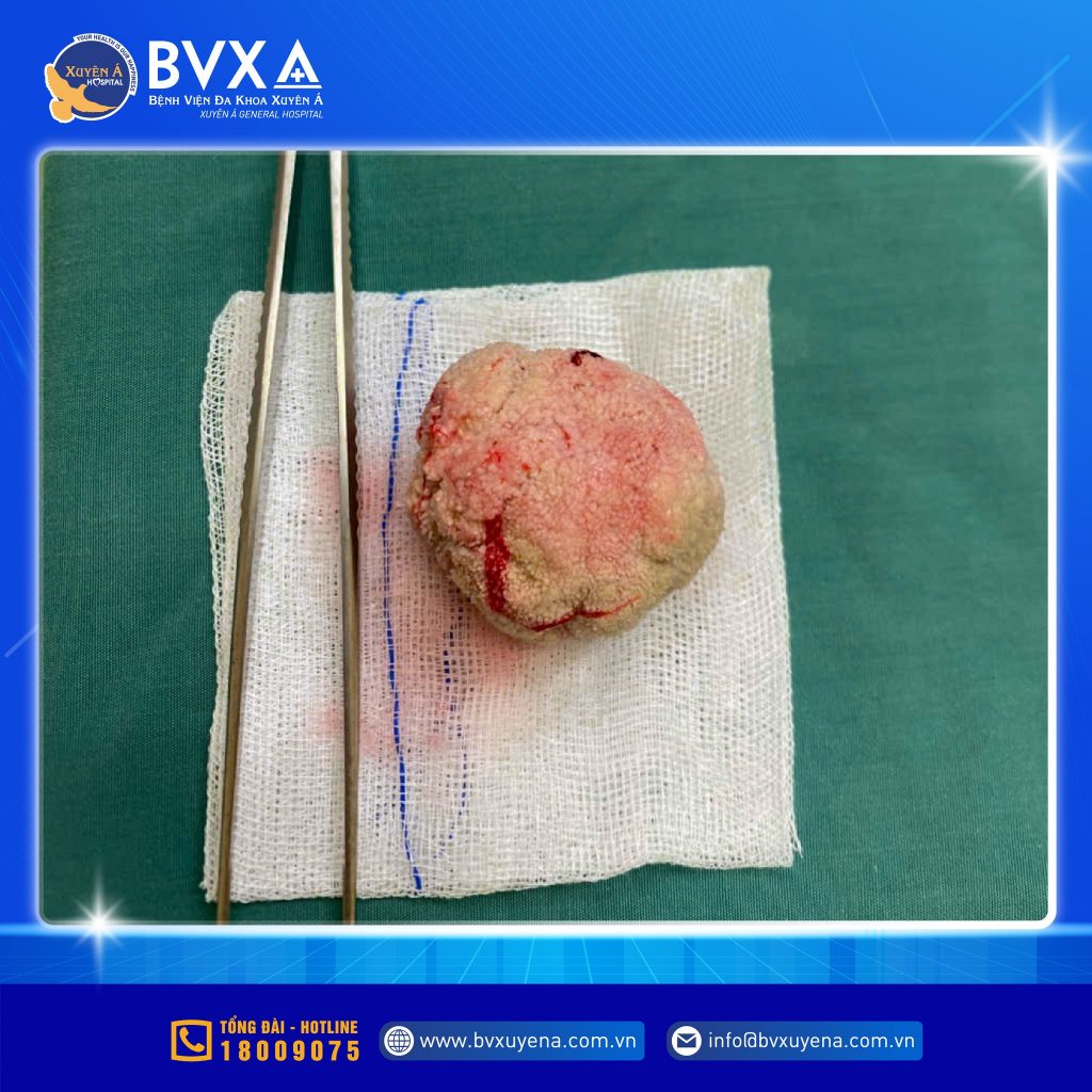 Hình ảnh viên sỏi bàng quang với kích thước như quả trứng gà