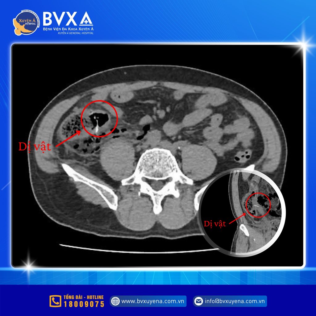 Hình ảnh CT của bệnh nhân bị thủng ruột vì nuốt vỏ thuốc