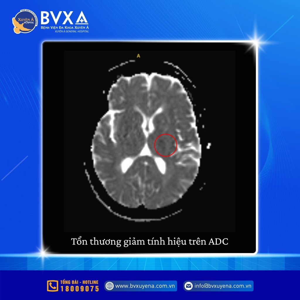 Tổn thương giảm tính hiệu trên ADC