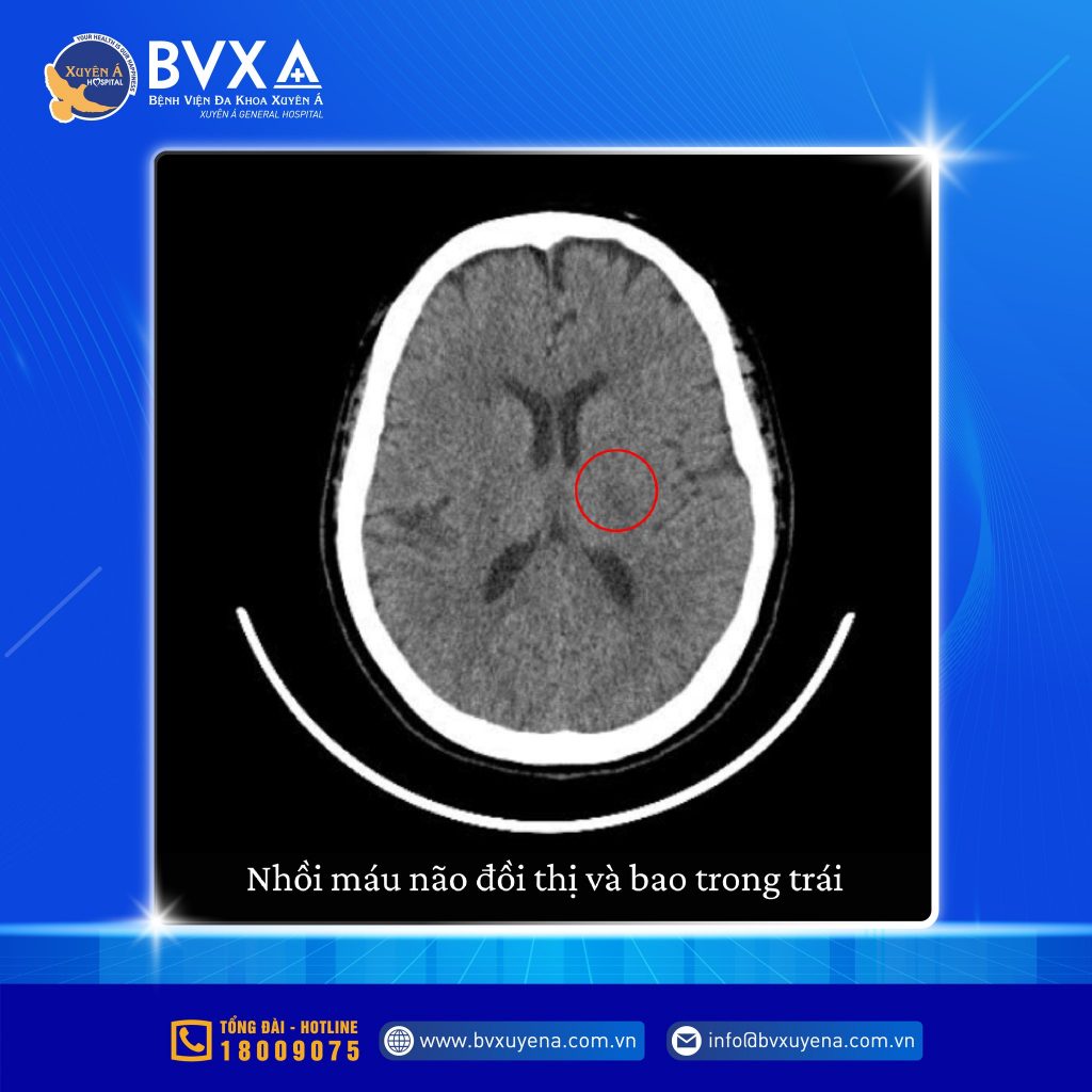 Hình ảnh nhồi máu não đồi thị và bao trong trái