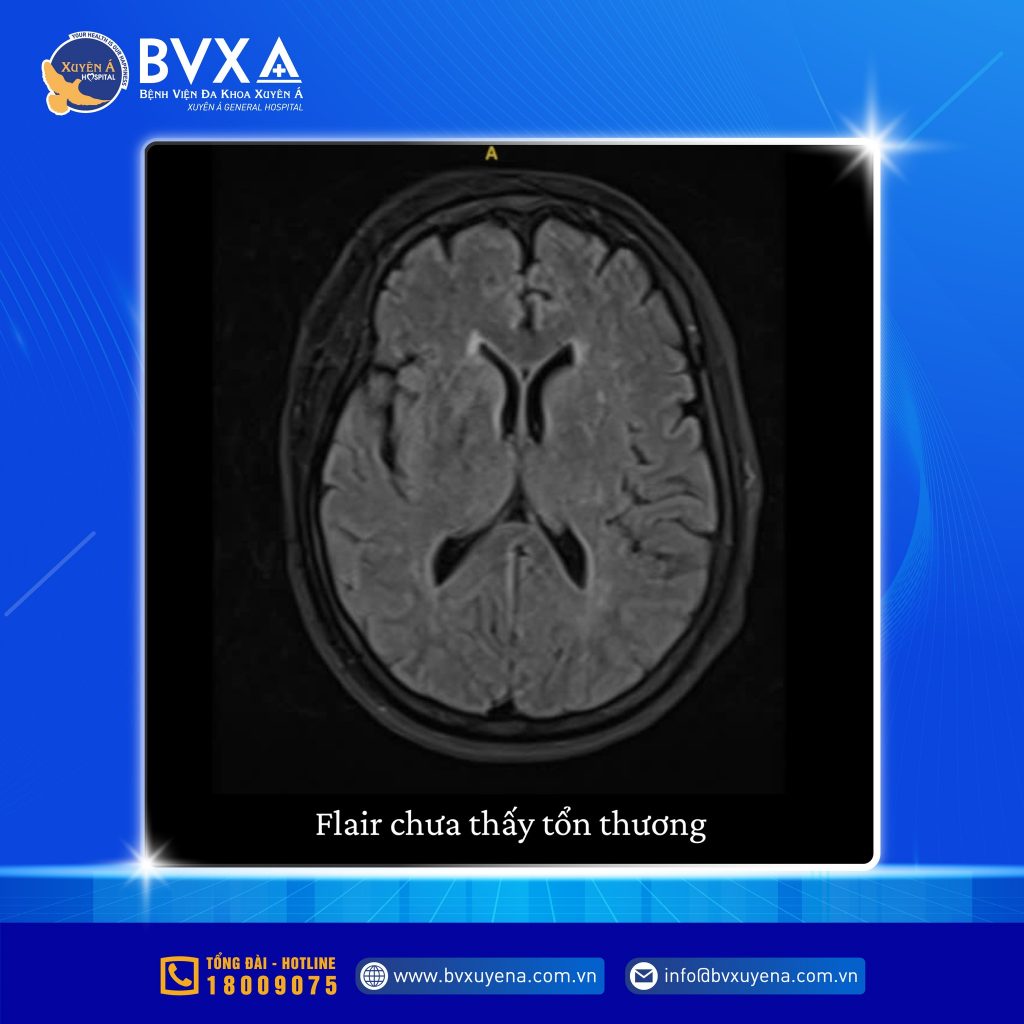 Hình ảnh Flair chưa thấy tổn thương