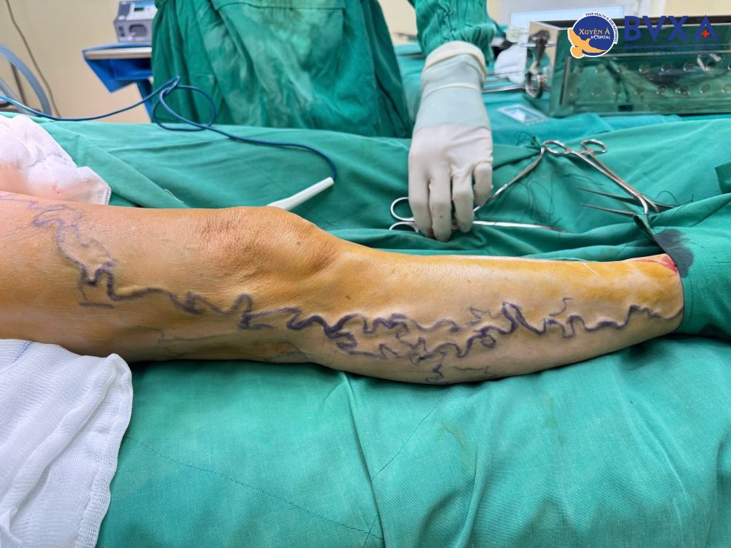 Hình ảnh bệnh nhân suy giãn tĩnh mạch chân