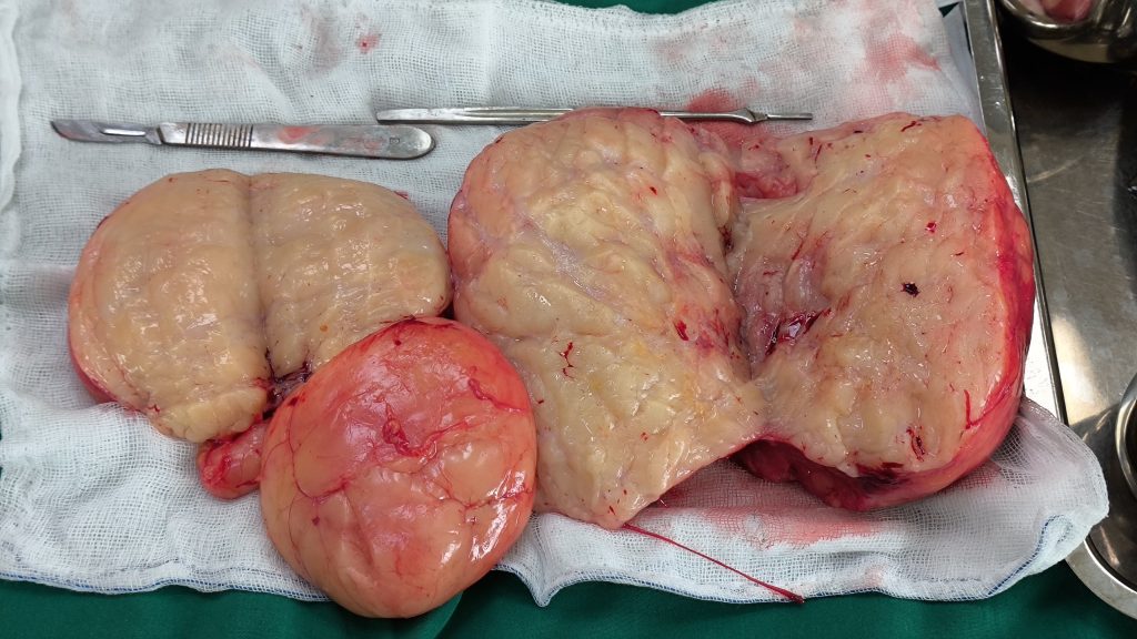 Hình ảnh ba khối bướu sarcoma được mang đi sinh thiết