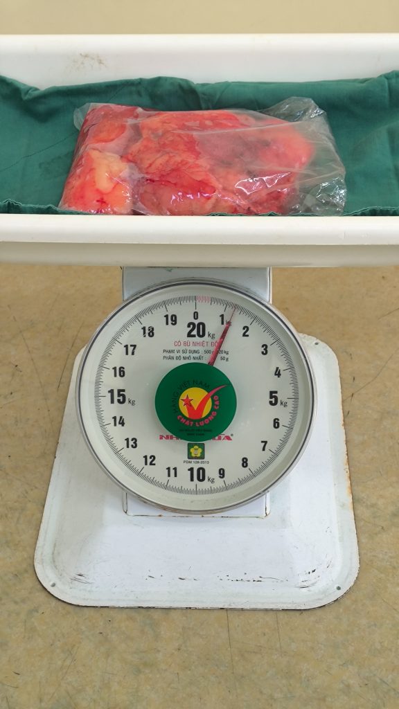 Hình ảnh ba khối bướu sarcoma nặng 1,5kg