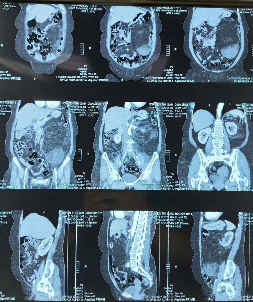 Hình ảnh CT ca bệnh bướu sarcoma