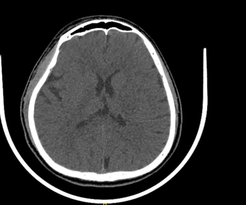 Hình chụp CT não bệnh nhân 33 tuổi bị đột quỵ