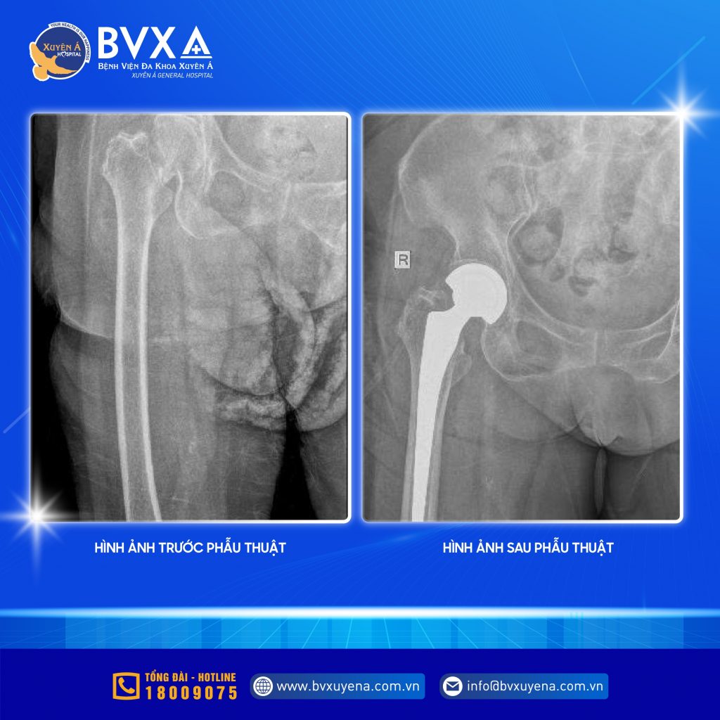 Hình ảnh X-quang cho thấy bà bị gãy cổ xương đùi bên phải và sau khi phẫu thuật