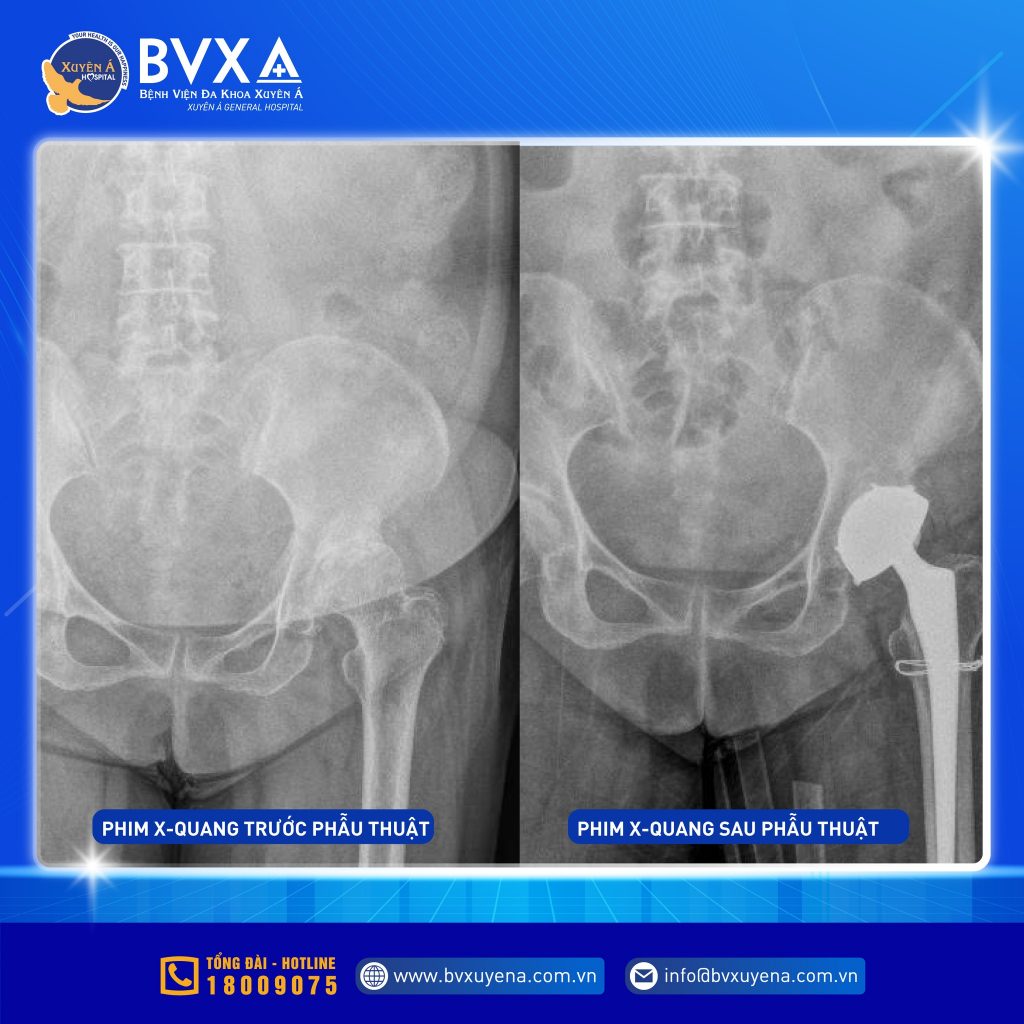 Hình ảnh X-quang trước và sau phẫu thuật thay khớp háng
