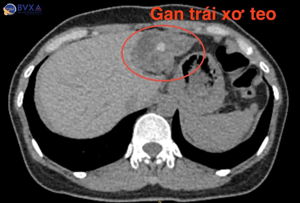 Hình ảnh CT phần gan bị xơ teo vì sỏi