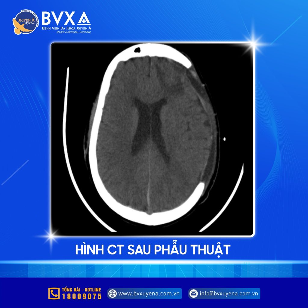 Hình ảnh CT sau phẫu thuật