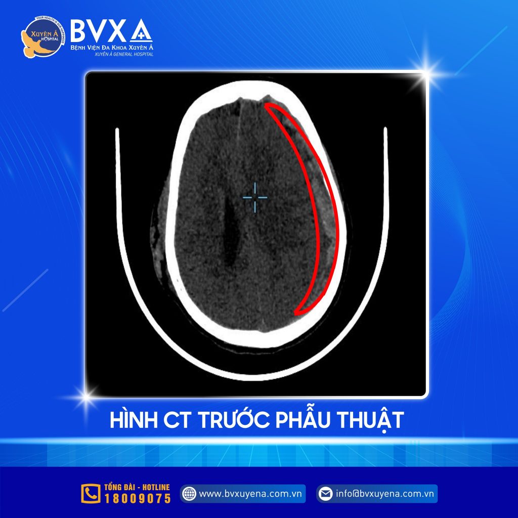Hình ảnh CT trước phẫu thuật