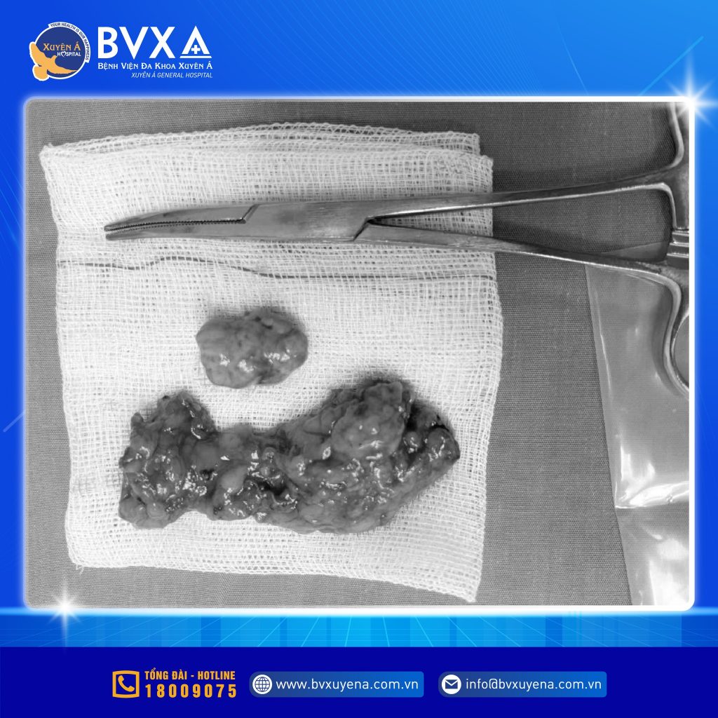 Hình ảnh khối ung bướu tuyến thượng thận