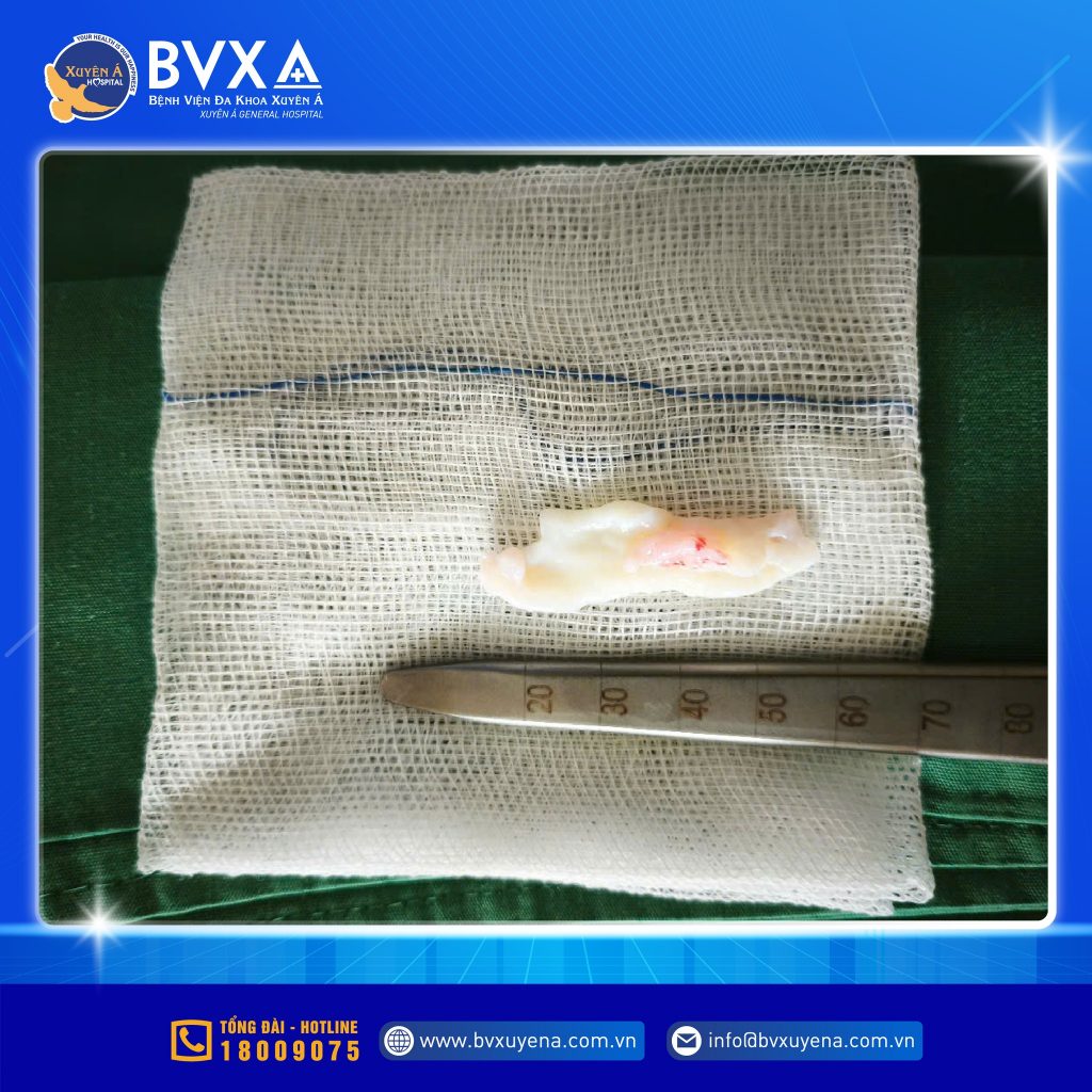 Hình ảnh nhân đĩa đệm được lấy ra