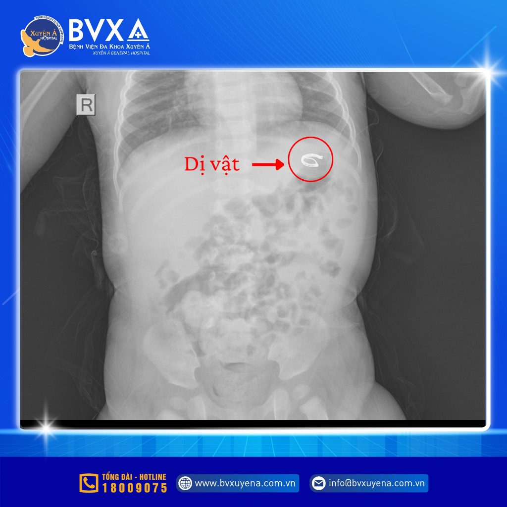 Hình ảnh chụp X-quang cho thấy có dị vật cản quang có thể là chiếc khuyên tai "đi lạc"