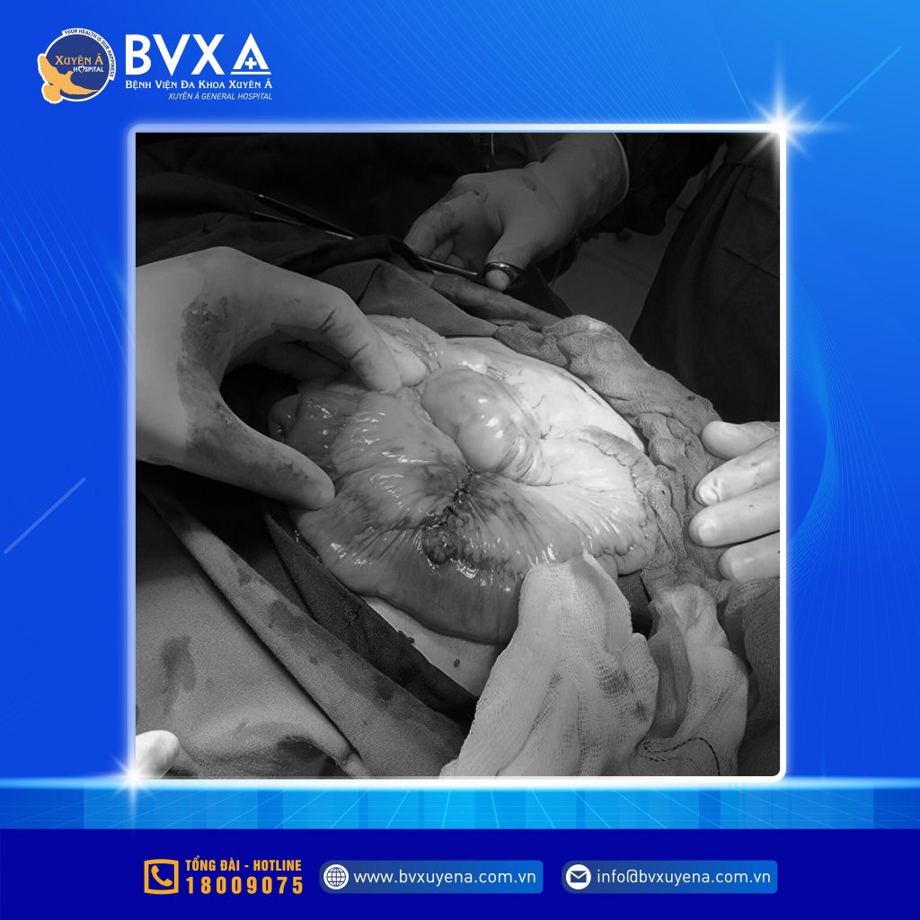 Hình ảnh quá trình mở ổ bụng của bệnh nhân vỡ động mạch mạc treo