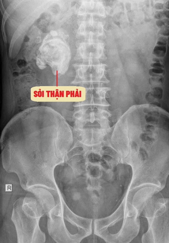 Hình ảnh CT cho thấy viên sỏi thận phải kích thước đến 8cm