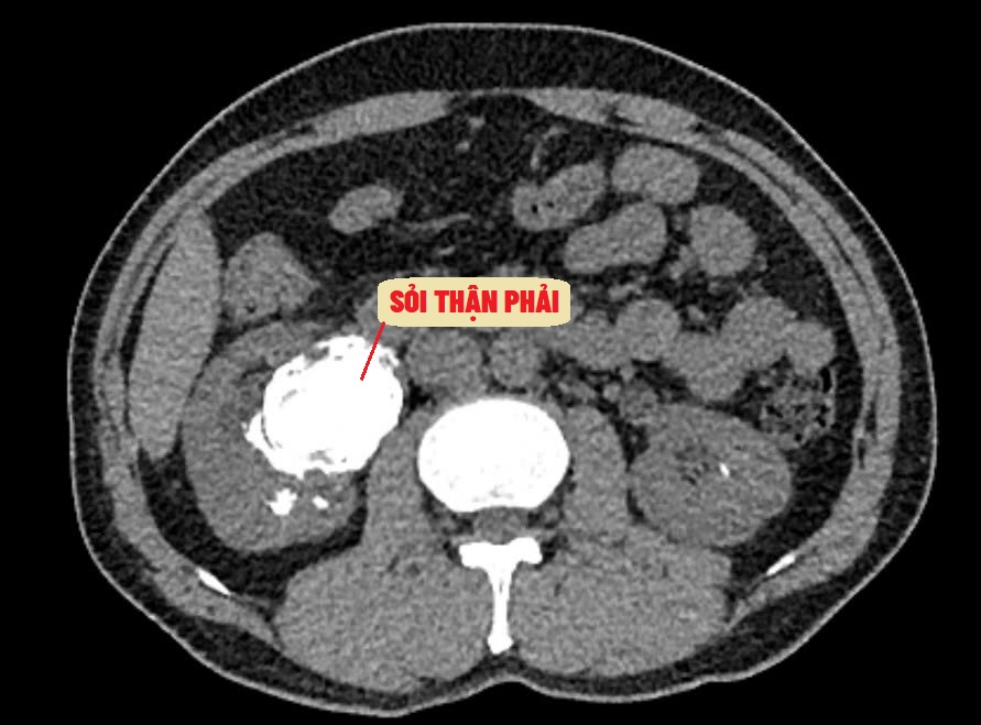 Hình ảnh CT phát hiện viên sỏi thận to như quả trứng ngỗng