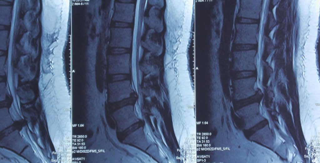 Hình ảnh MRI cho thấy tình trạng thoát vị đĩa đệm chèn ép nặng ống sống và rễ thần kinh