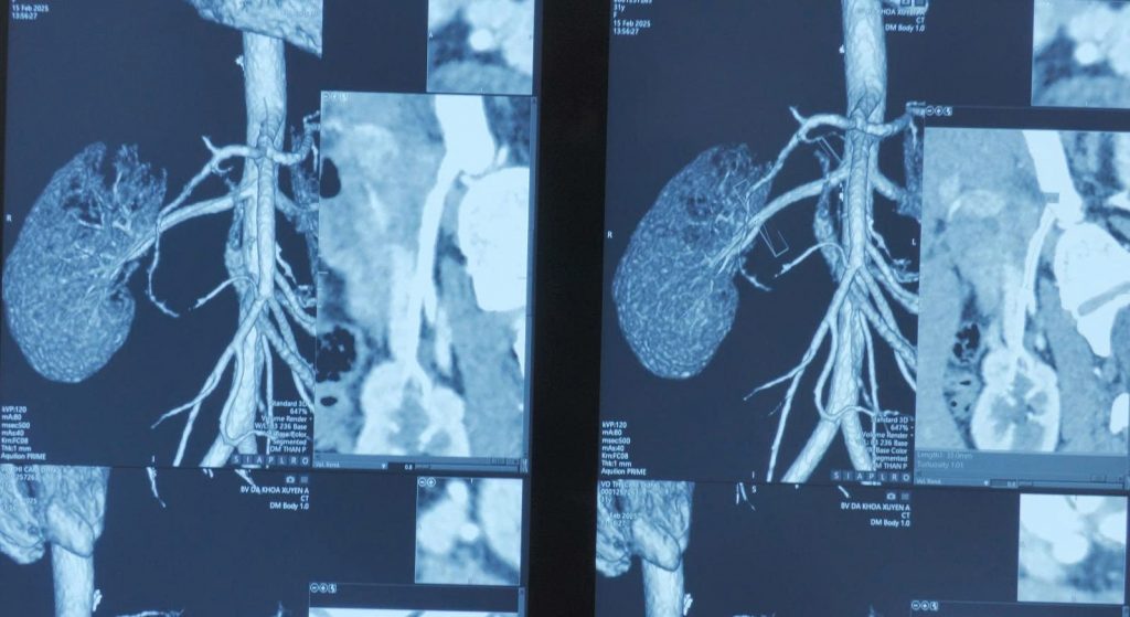Hình ảnh MRI thận bệnh  nhân suy thận mạn