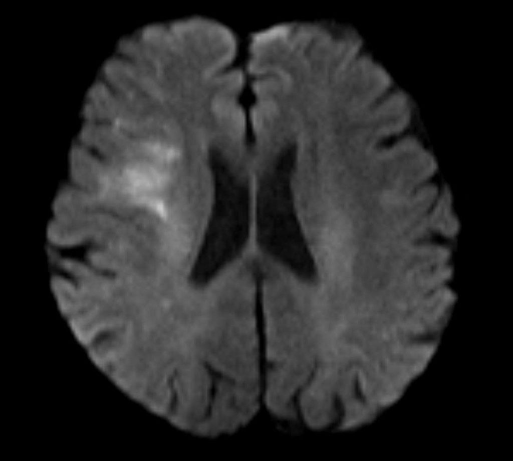 Hình MRI bệnh nhân T.L bị đột quỵ