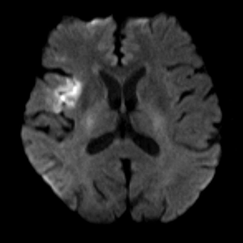 Hình MRI bệnh nhân T.L bị đột quỵ