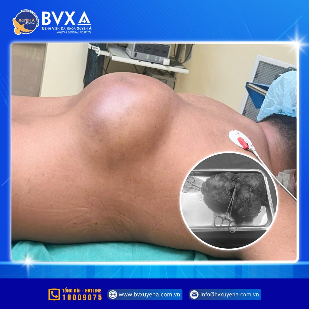 Hình ảnh khối u khổng lồ trên lưng bệnh nhân