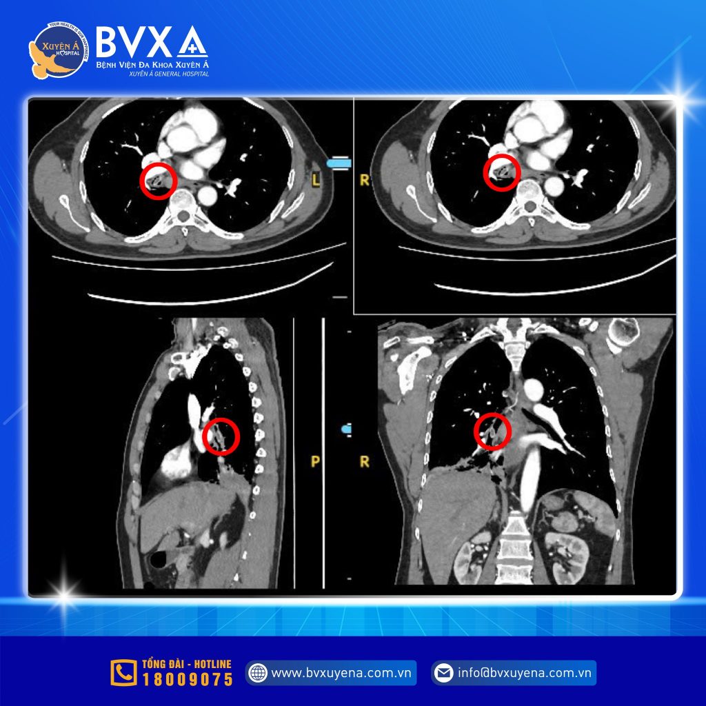 Hình ảnh CT lồng ngực xác định nguyên nhân của việc ho dai dẳng