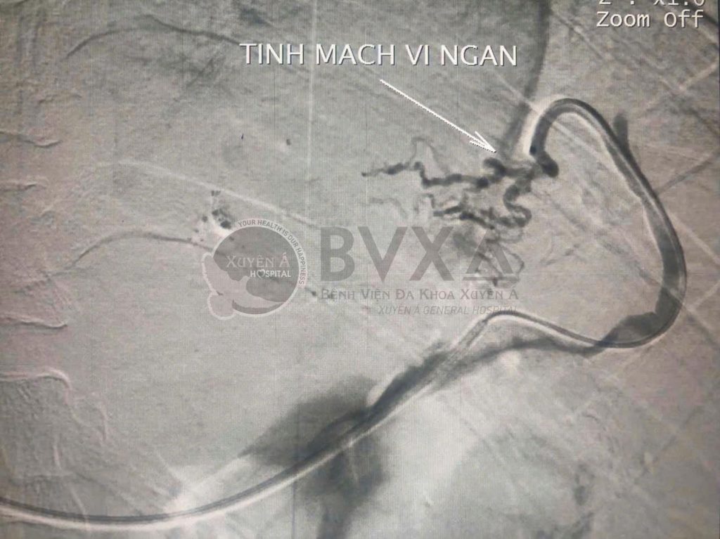 Hình ảnh cận lâm sàng của bệnh nhân vỡ giãn tĩnh mạch