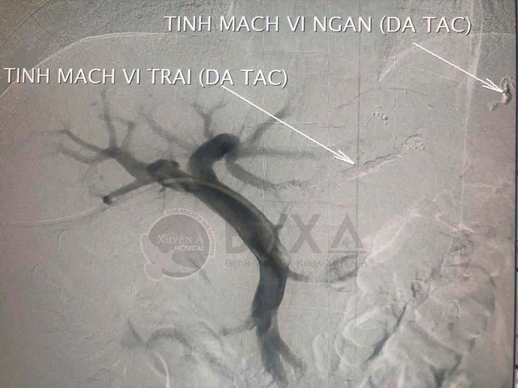 Hình ảnh cận lâm sàng của bệnh nhân vỡ giãn tĩnh mạch