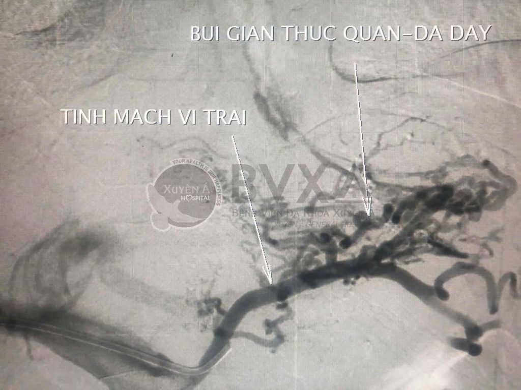 Hình ảnh cận lâm sàng của bệnh nhân vỡ giãn tĩnh mạch