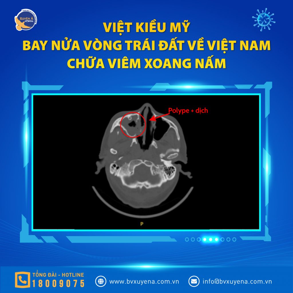 Hình ảnh CT của bệnh nhân viêm xoang nấm