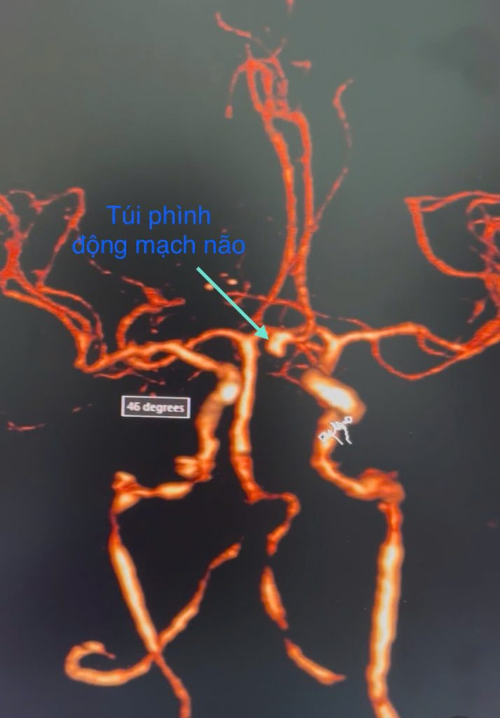 Hình ảnh CT tui phình trước mổ của bệnh nhân vỡ túi phình động mạch não