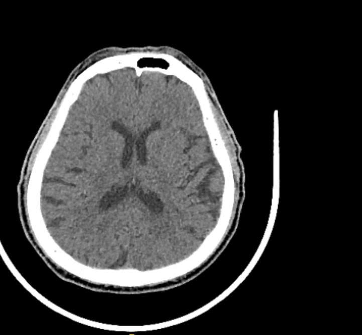 Hình CT trước thiệp của bệnh nhân đột quỵ