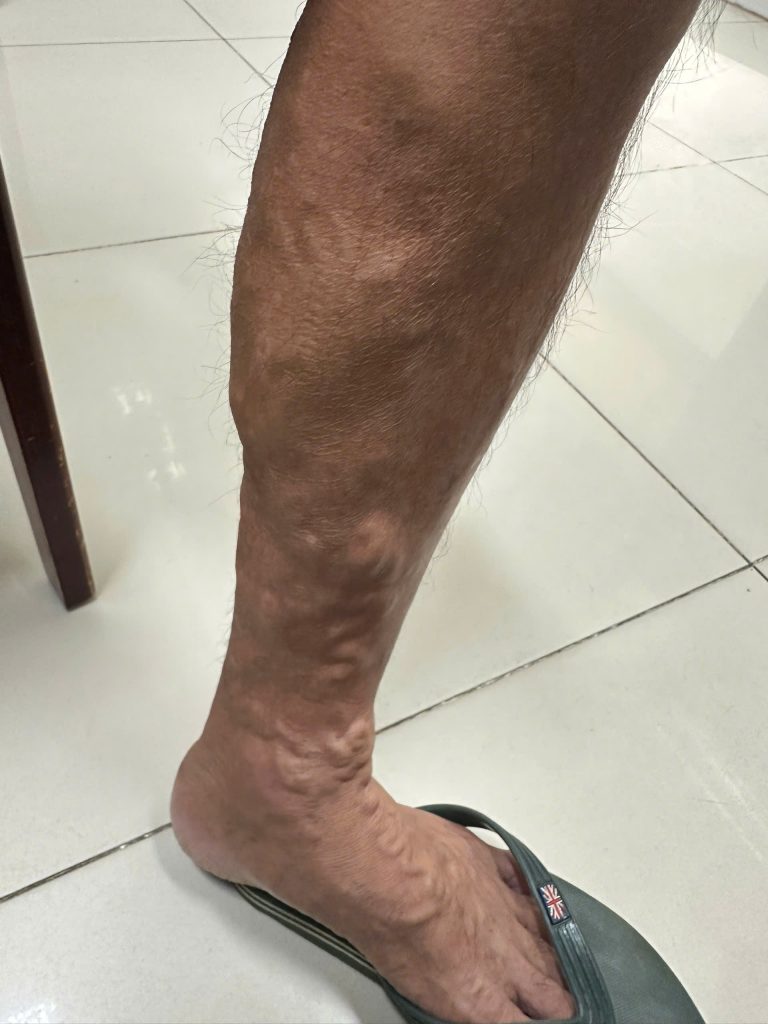 Hình ảnh chân trái bị suy giãn tĩnh mạch trước phẫu thuật