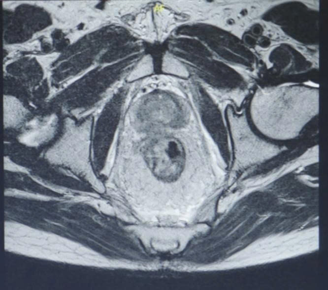 Hình ảnh CT sau xạ trị khối ung thư trực tràng được thu nhỏ