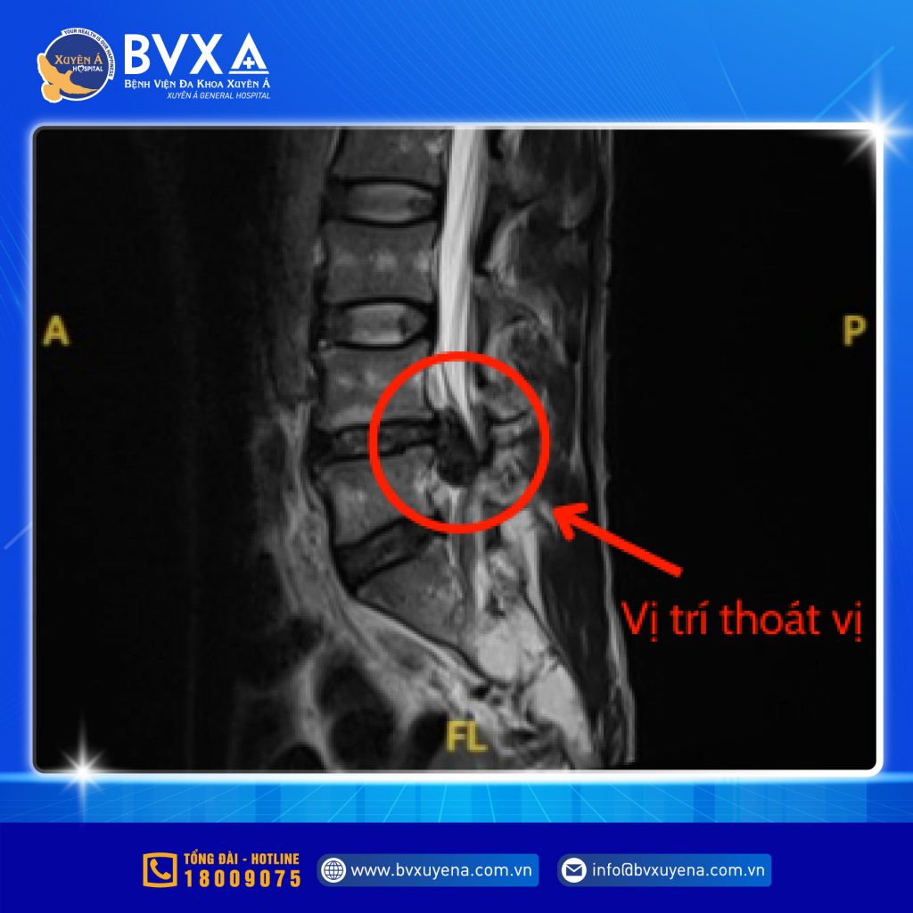 Hình ảnh MRI cho thấy vị trí thoát vị