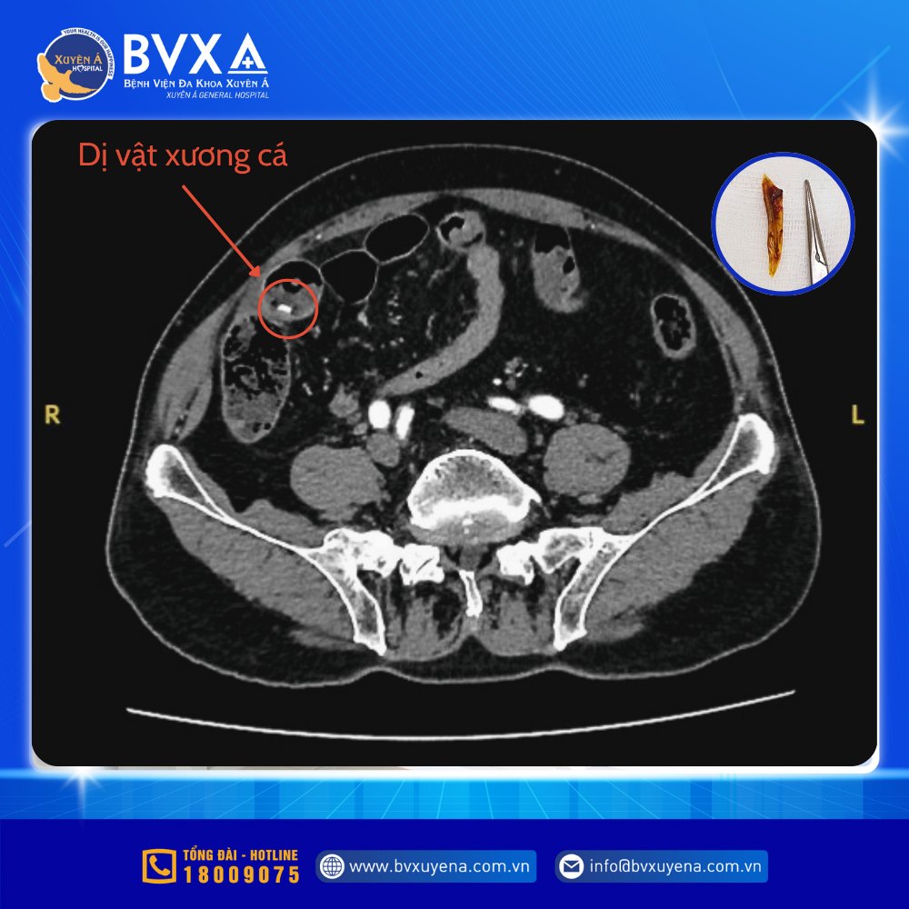 Hình ảnh cận lâm sàng cho thấy xương cá đâm xuyên thành manh tràng