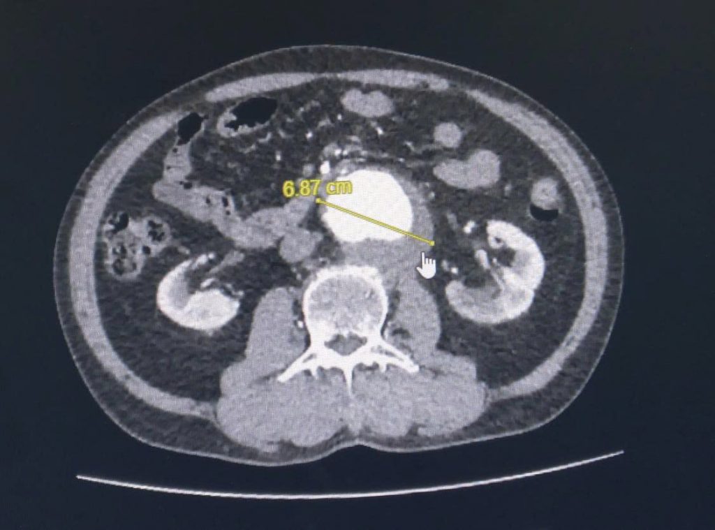 Hình ảnh MRI của ông cụ bị túi phình động mạch chủ bụng