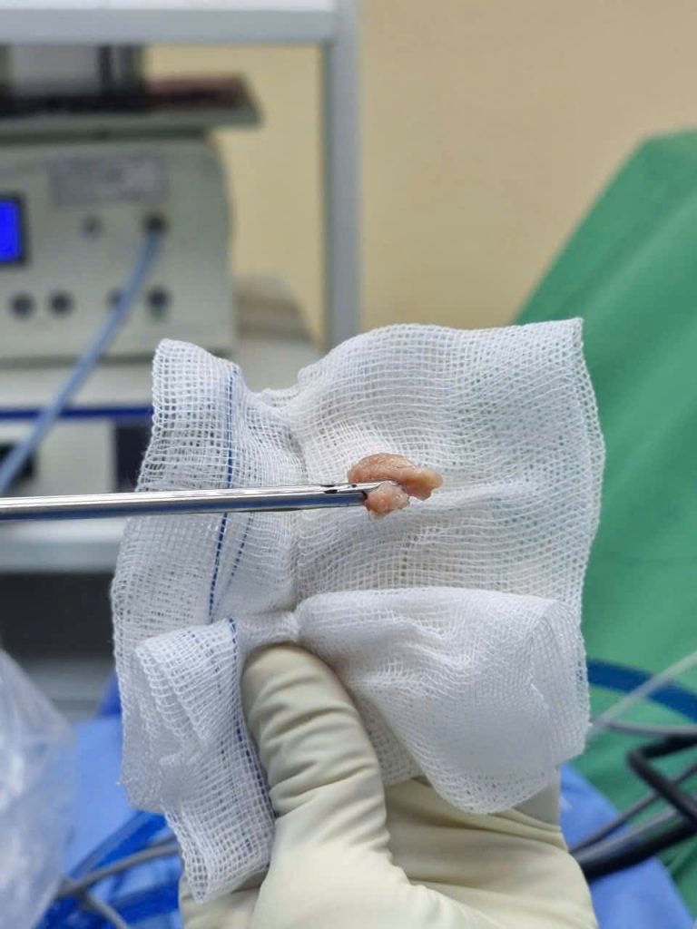 Hình ảnh nhân thoát vị đệm được lấy ra sau phẫu thuật nội soi cột sống thức tỉnh