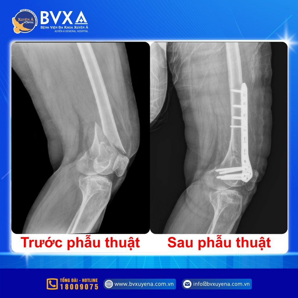 Hình ảnh X-Quang trước vào sau phẫu thuật vì chấn thương do tai nạn giao thông
