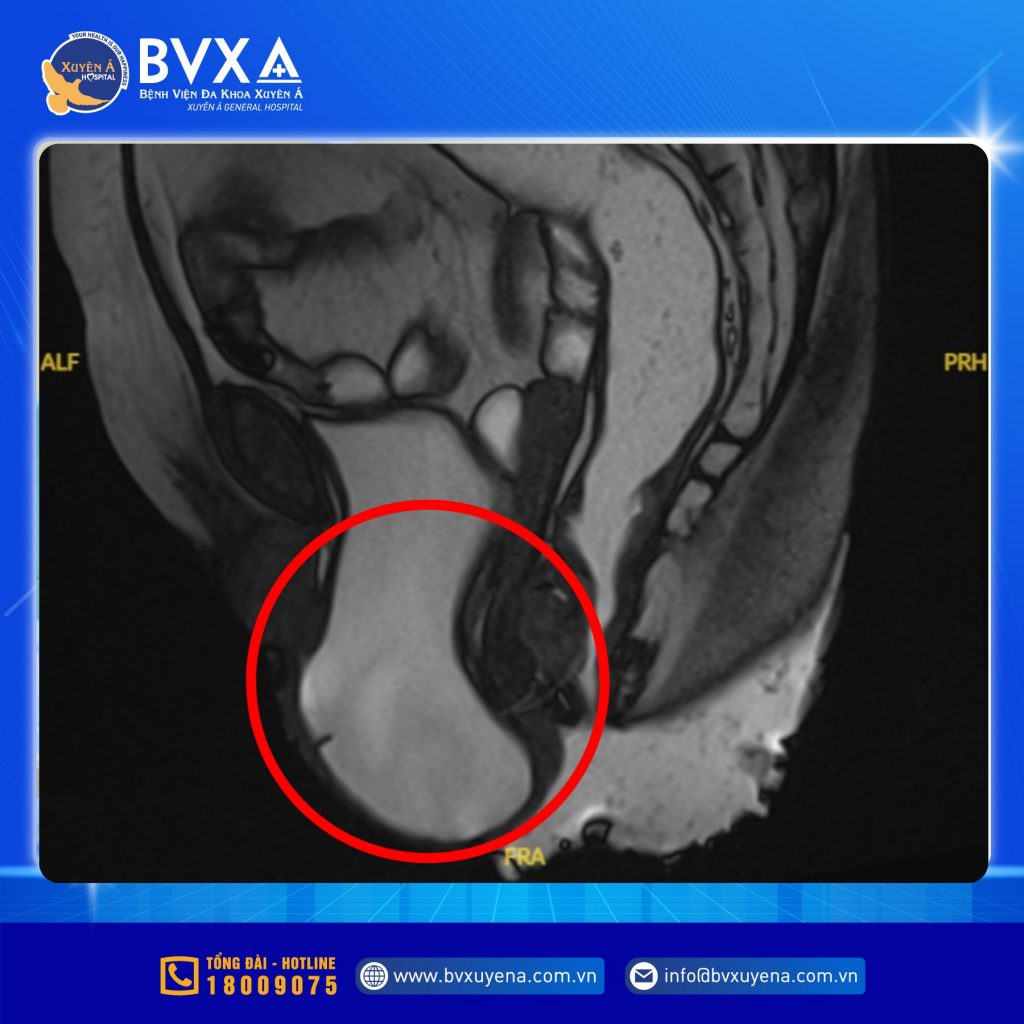 Hình ảnh cận lâm sàng cho thấy bệnh nhân bị sa sàn chậu độ III, sa bàng quang độ III và sa tử cung độ II